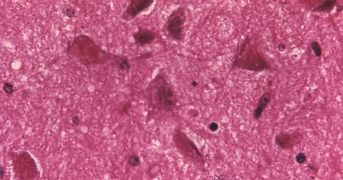 CDC rabies warning with wildlife safety guidance and medical caution
