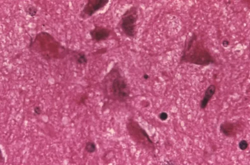 CDC rabies warning with wildlife safety guidance and medical caution